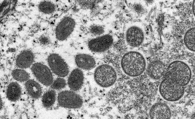 variole du singe monkeypox